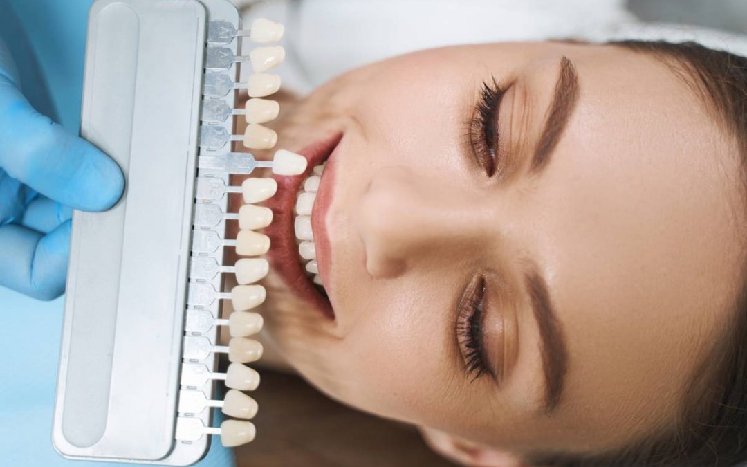 8 questions que vous vous posez sur les facettes dentaires